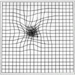 Age-Related Macular Degeneration