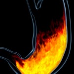 heartburn home remedies